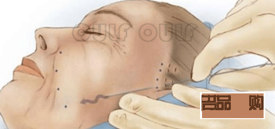 手术美容线多少钱(手术美容线多少钱一根)