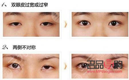 <h3>什么双眼皮最便宜</h3> <h3>什么双眼皮最便宜</h3>