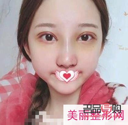 <h3>什么双眼皮最便宜</h3> <h3>什么双眼皮最便宜</h3>