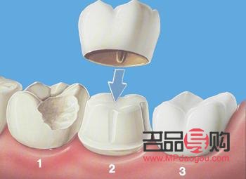 美容牙冠好吗(美容牙冠好吗安全吗)