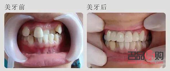 美容牙冠好吗(美容牙冠好吗安全吗)