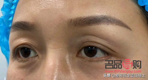 探究上眼皮松弛严重问题及其解决方案