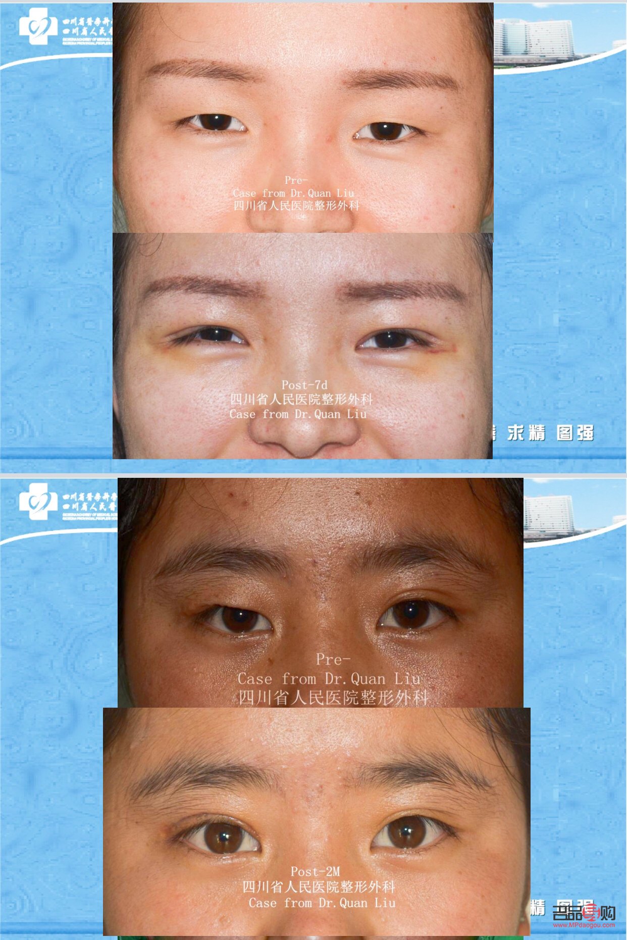 大综合双眼皮案例图片(大综合双眼皮案例图片高清)