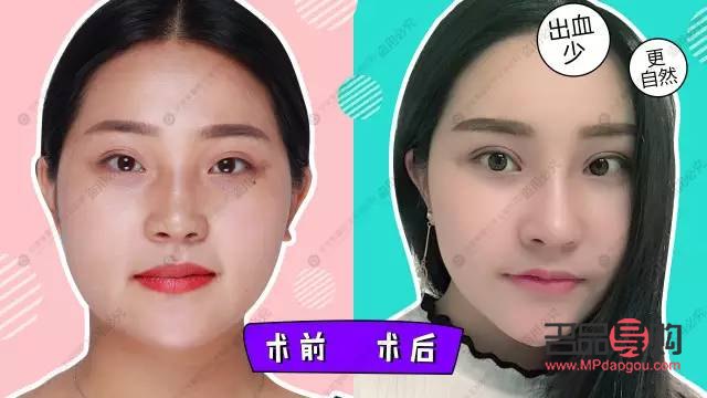 做双眼皮具备的条件(做双眼皮具备的条件是什么) 做双眼皮具备的条件(做双眼皮具备的条件是什么)