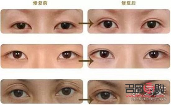 <h3>双眼皮做窄了能修复吗?</h3> <h3>双眼皮做窄了能修复吗?</h3>