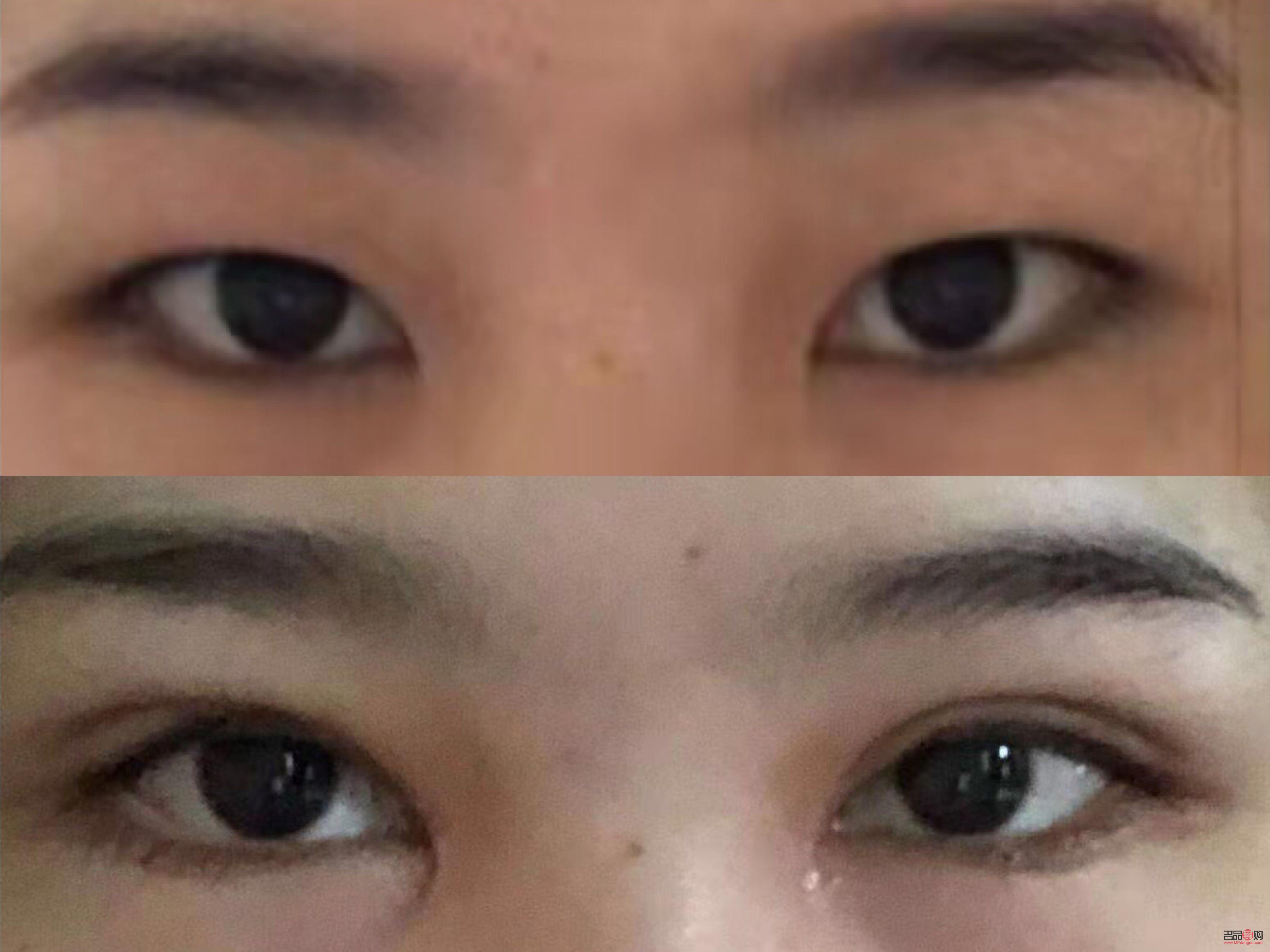 <h3>大小眼可以割双眼皮吗</h3> <h3>大小眼可以割双眼皮吗</h3>