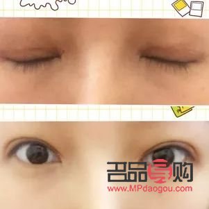 <h3>大小眼可以割双眼皮吗</h3> <h3>大小眼可以割双眼皮吗</h3>