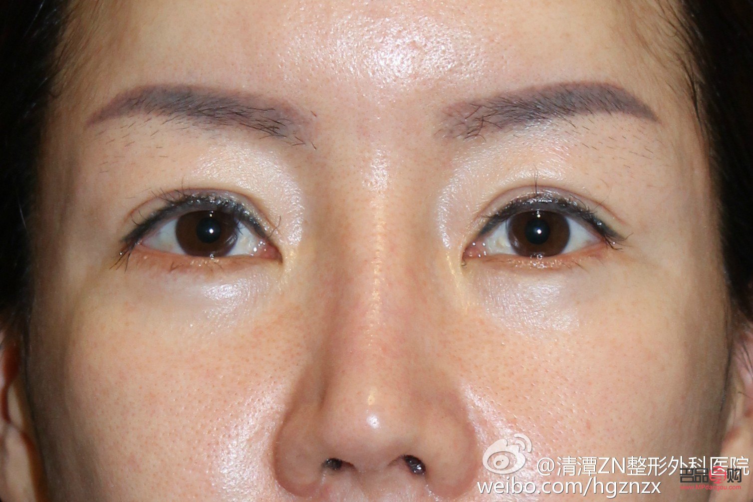 <h3>眼角下垂怎么提升和紧致眼角</h3>