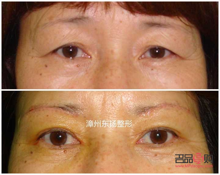 <h3>眼角下垂怎么提升和紧致眼角</h3>