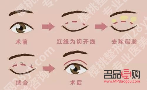 <h3>双眼皮二次修复最佳时间：师丽丽专业解读</h3>