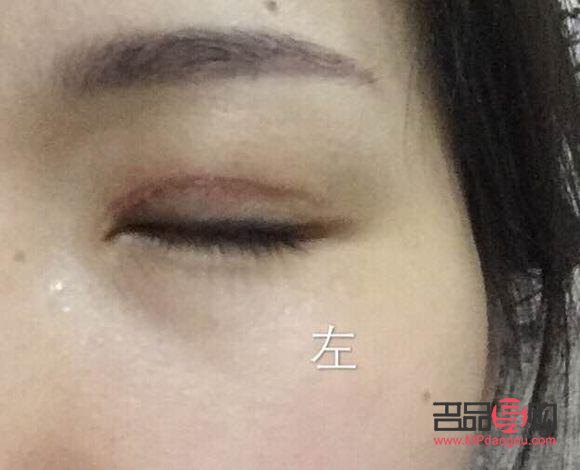 <h3>全切双眼皮多久能恢复正常颜色</h3>