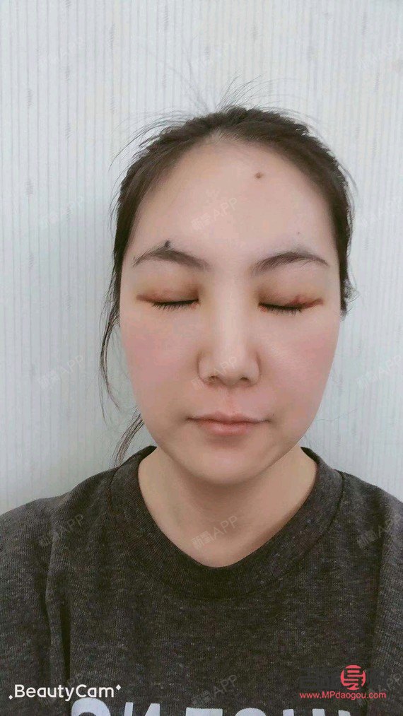 上眼皮抽脂是永久的吗(上眼皮抽脂是永久的吗) 上眼皮抽脂是永久的吗(上眼皮抽脂是永久的吗)