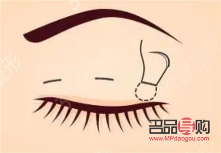 上眼皮抽脂是永久的吗(上眼皮抽脂是永久的吗)