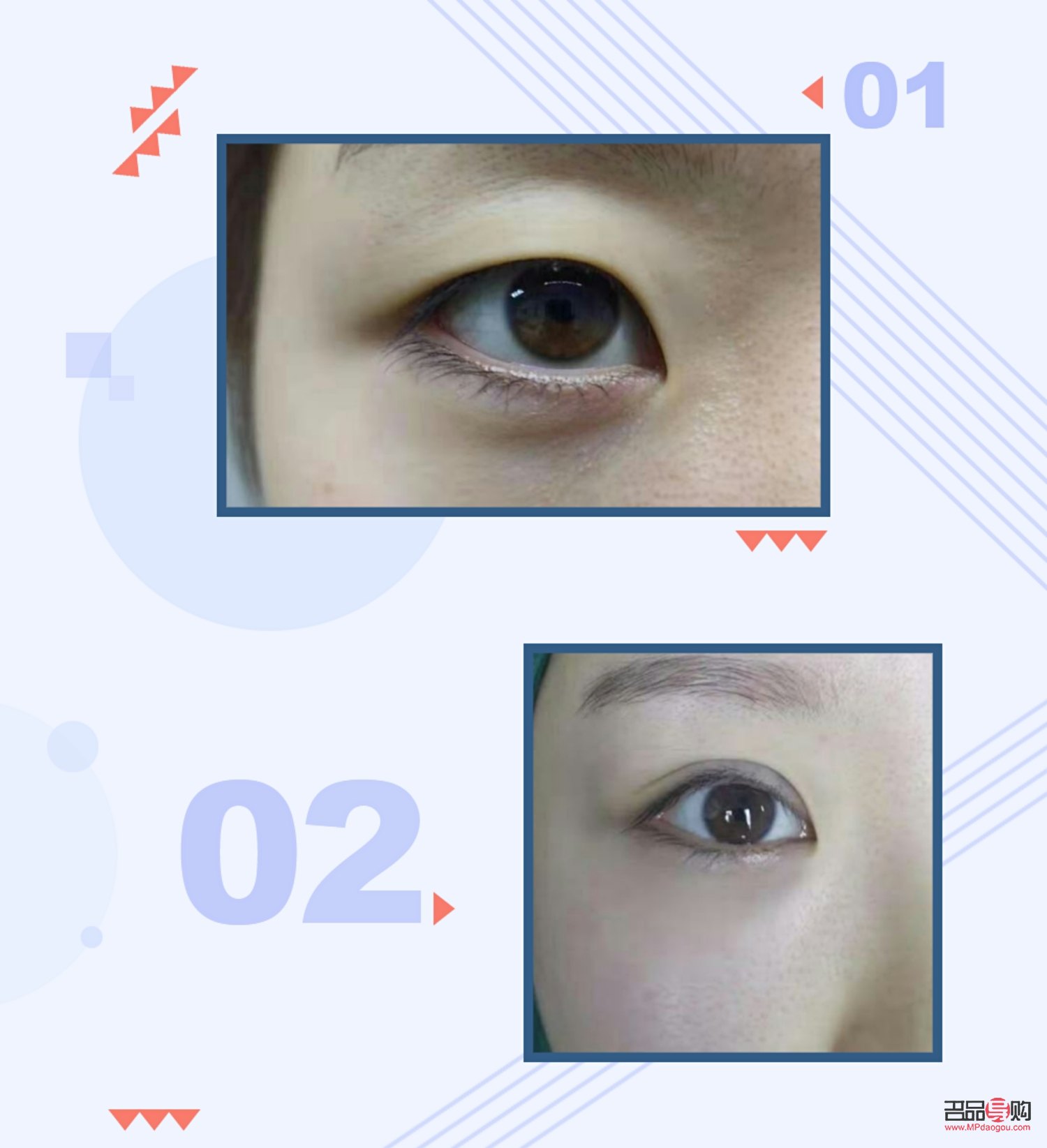 割双眼皮手术多久恢复(割双眼皮手术多久恢复正常)