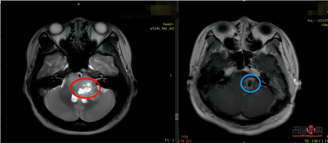 <h3>全切眼综合手术费用详解</h3>