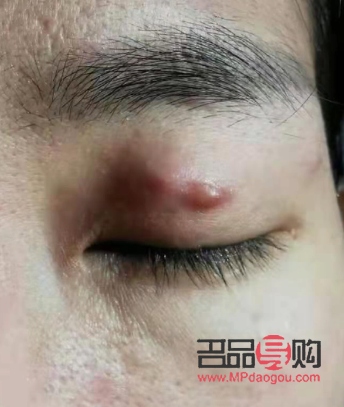 男生有必要去割双眼皮吗(男生有必要去割双眼皮吗图片) 男生有必要去割双眼皮吗(男生有必要去割双眼皮吗图片)