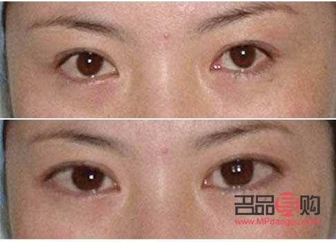 眼睛小做眼综合会变大吗(眼睛小做眼综合会变大吗图片)