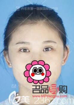 双眼皮7mm恢复后多宽图片女(双眼皮7mm恢复后多宽图片女生) 双眼皮7mm恢复后多宽图片女(双眼皮7mm恢复后多宽图片女生)