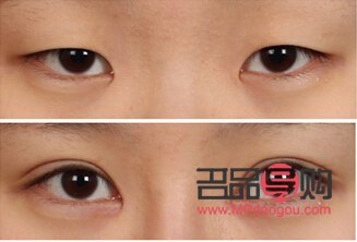 双眼皮7mm恢复后多宽图片女(双眼皮7mm恢复后多宽图片女生) 双眼皮7mm恢复后多宽图片女(双眼皮7mm恢复后多宽图片女生)