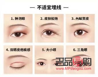 无痕迹双眼皮与埋线双眼皮的区别详解