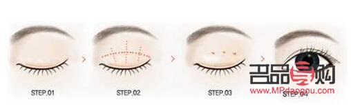 无痕迹双眼皮与埋线双眼皮的区别详解