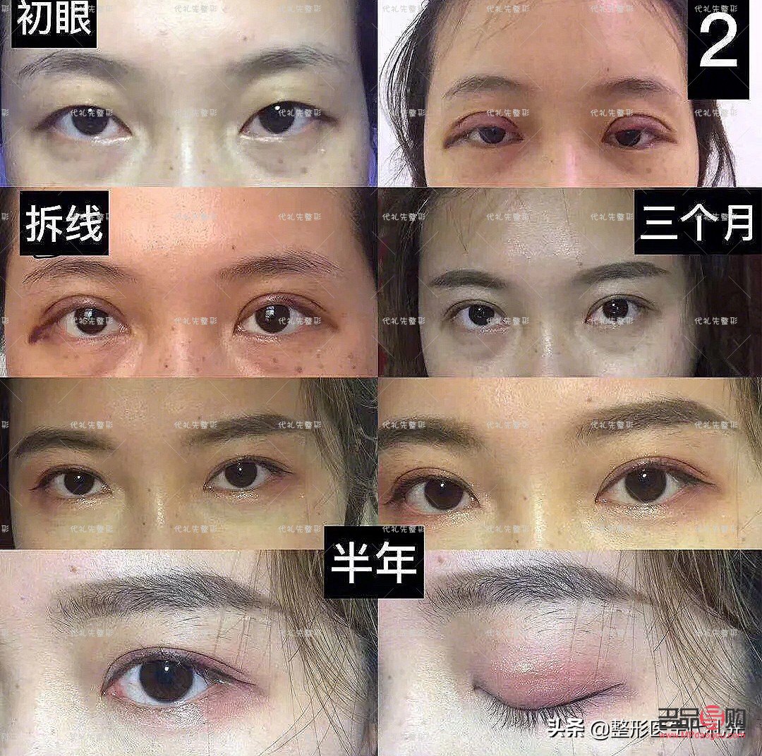 <h3>全切双眼皮修复手术费用详解</h3> <h3>全切双眼皮修复手术费用详解</h3>