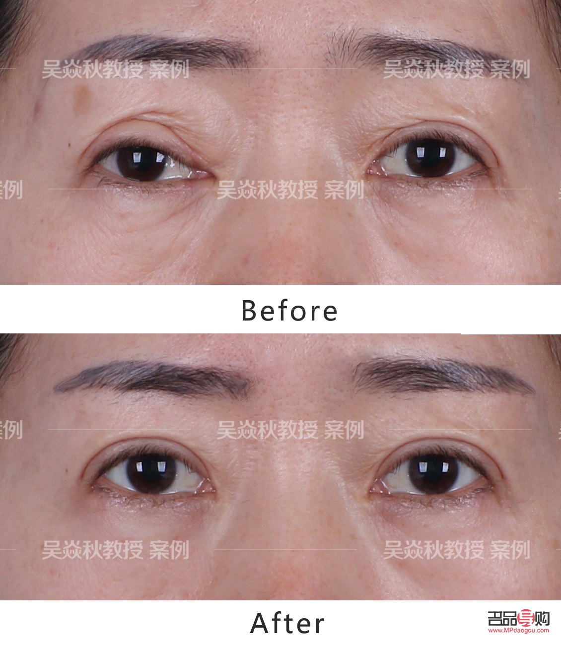 全切双眼皮修复手术费用详解