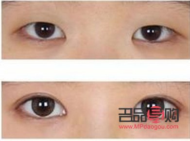 <h3>多层眼皮是否适合进行双眼皮手术？</h3>