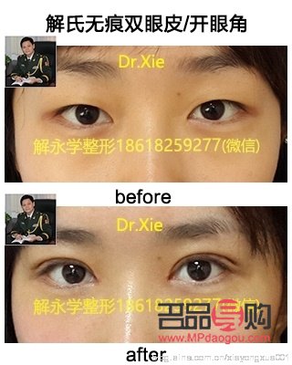 <h3>多层眼皮是否适合进行双眼皮手术？</h3>