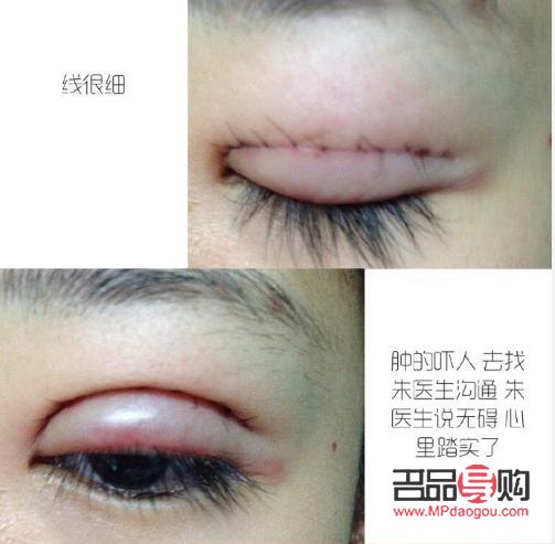 埋线跟全切双眼皮哪个好(埋线跟全切双眼皮哪个好点)