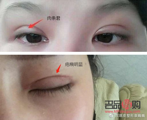 埋线跟全切双眼皮哪个好(埋线跟全切双眼皮哪个好点)