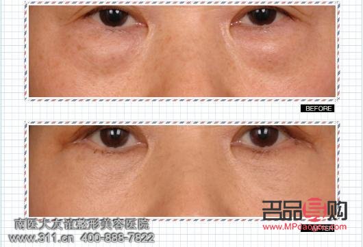 vottov去眼袋怎么样(vmax去眼袋)