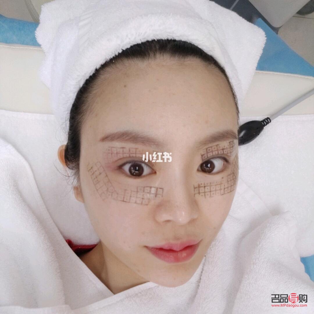 眼部热玛吉有恢复期吗(眼部热玛吉多久恢复)