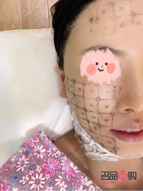 眼部热玛吉有恢复期吗(眼部热玛吉多久恢复)