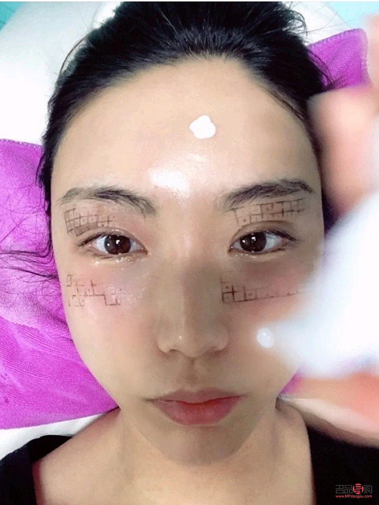 眼部热玛吉有恢复期吗(眼部热玛吉多久恢复)