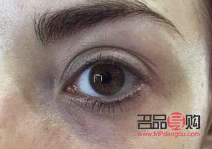 紫色黑眼圈怎么去除(紫色黑眼圈怎么去除小妙招)