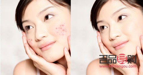 美容院排痘痘好吗(美容院排痘痘好吗知乎)