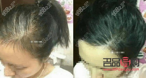 植发属于美容吗(植发属于美容吗知乎)