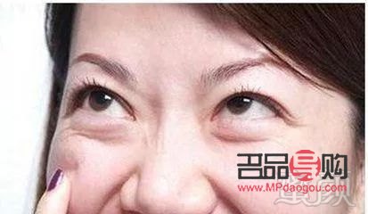 <h3>脂肪型眼袋的成因及解决方法探析</h3>