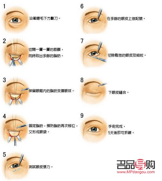 <h3>脂肪型眼袋的成因及解决方法探析</h3>