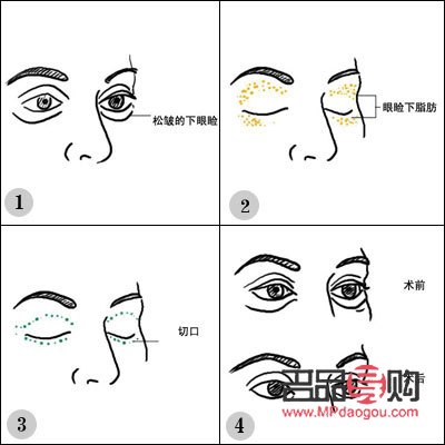 给眼皮抽脂要多少钱？全面解析眼皮抽脂价格因素