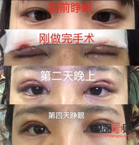 7.5mm开扇双眼皮(7.5mm开扇双眼皮图片)