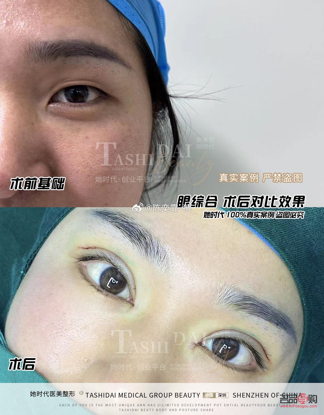 <h3>全切加眼综合</h3>——打造迷人电眼新选择 <h3>全切加眼综合</h3>——打造迷人电眼新选择