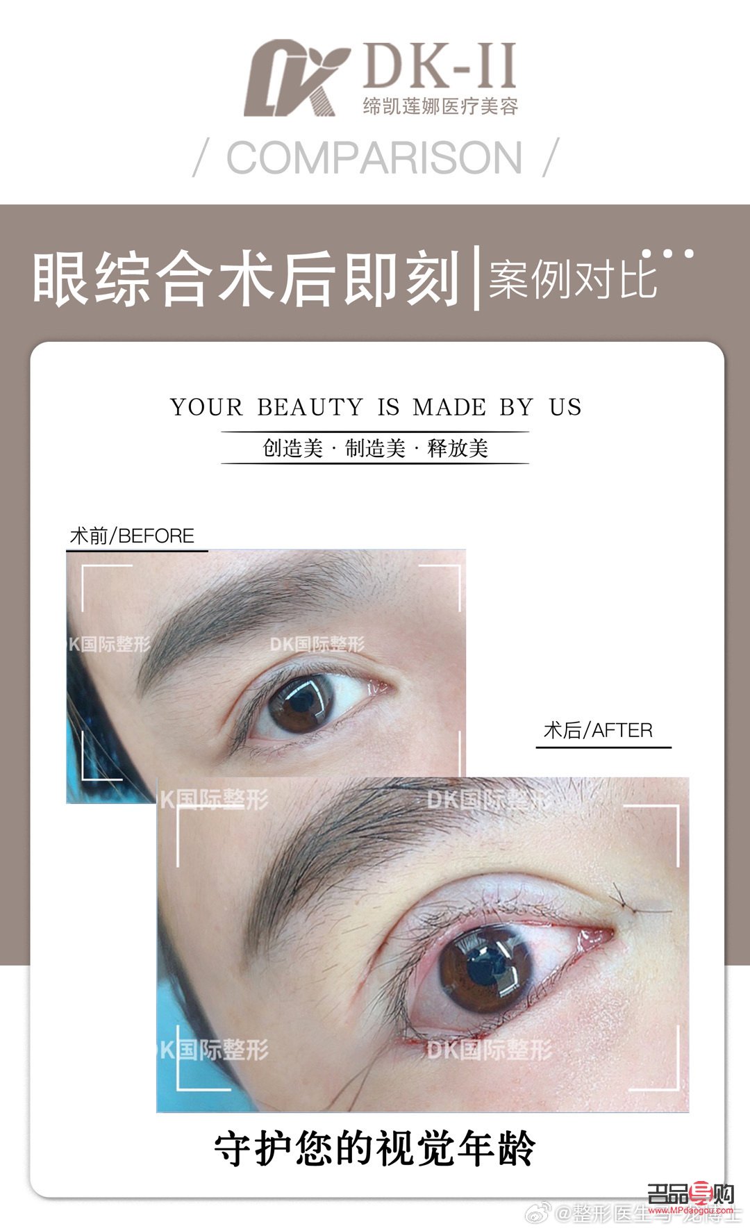 全切加眼综合——打造迷人电眼新选择