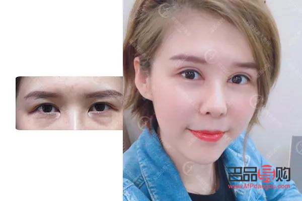 开扇形双眼皮真人图片(开扇形双眼皮的图片)