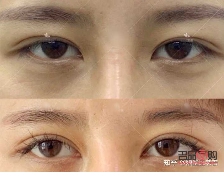 <h3>眼距宽割双眼皮时是否需要开眼角？</h3>