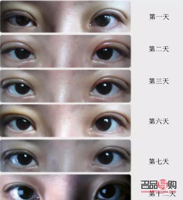 <h3>眼距宽割双眼皮时是否需要开眼角？</h3>