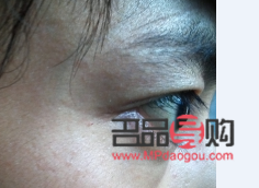 眼睛角有一小块肉突出怎么办(眼睛角有一小块肉突出怎么办图片)