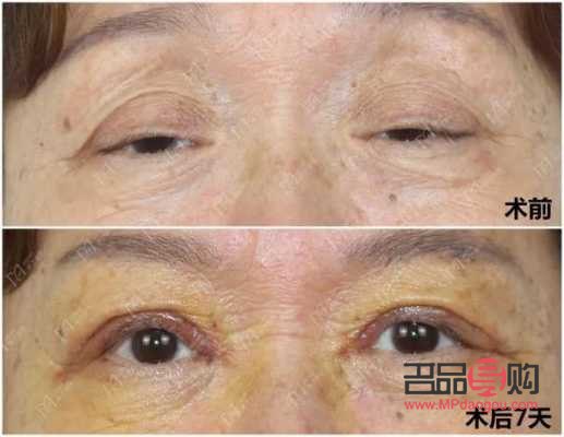 眼皮松弛下垂手术前后对比照片(眼皮松弛下垂手术多长时间恢复)
