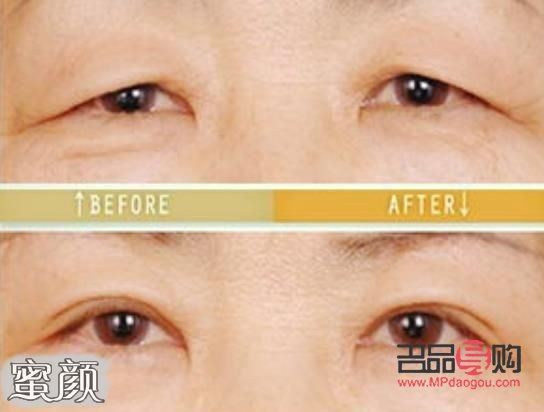 眼皮松弛下垂手术前后对比照片(眼皮松弛下垂手术多长时间恢复)